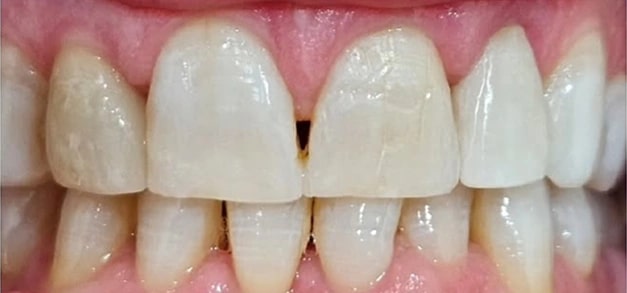 Dental Veneers before in Burbank Dentist