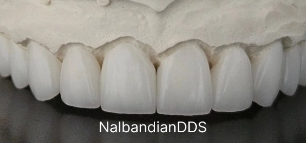 Dental veneers in Burbank,CA