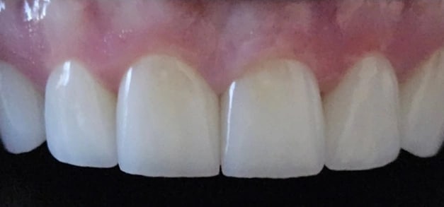 Teeth Whitening in Burbank, CA