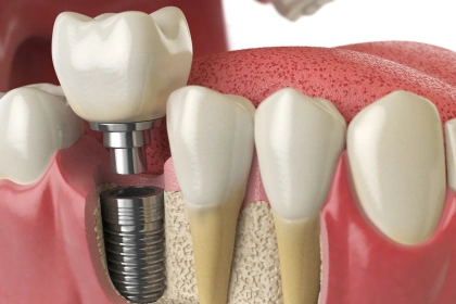 dental implant process in Burbank