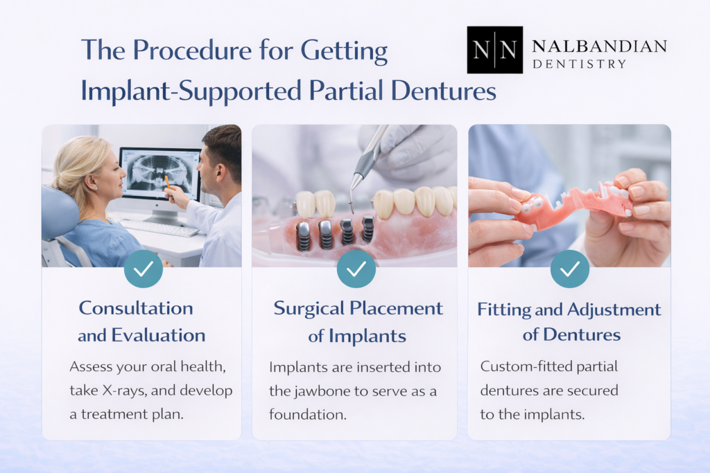 Procedure for Getting Implant-Supported Partial Dentures
