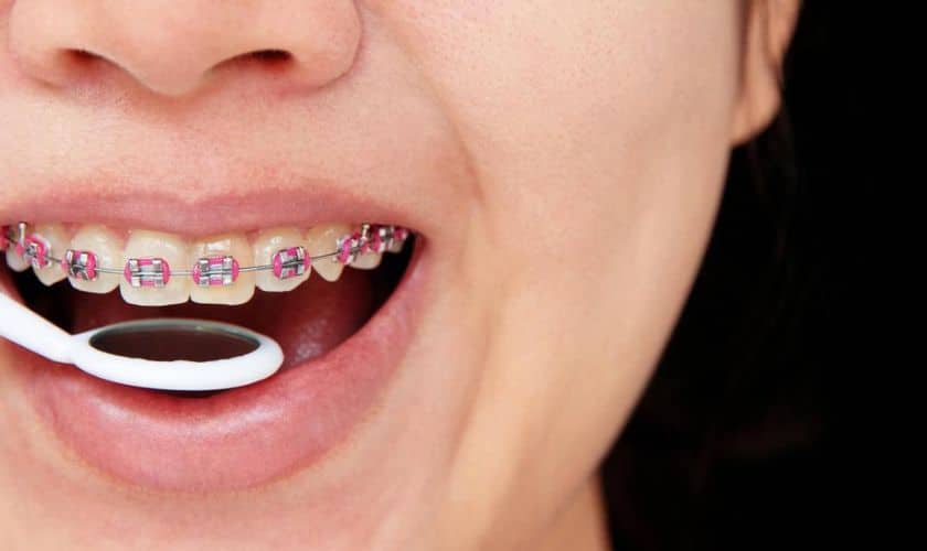 White Spots on Teeth