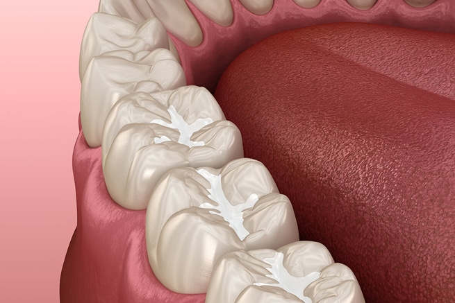 Why Dentists Recommend Dental Sealants for Patients