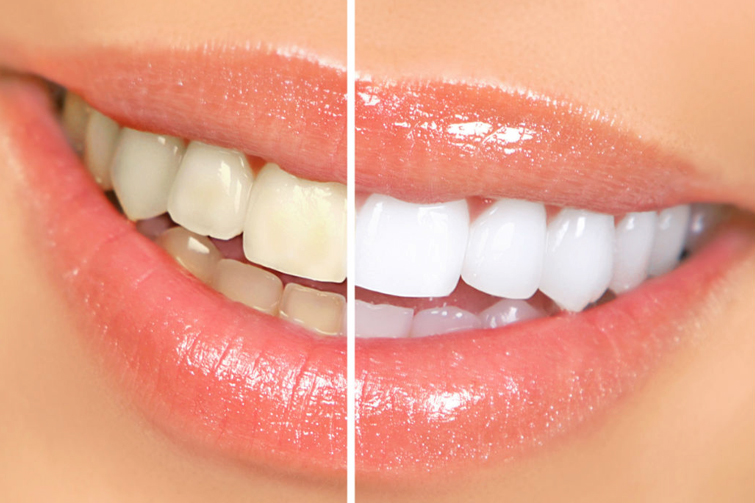 Good Candidate for Teeth Whitening