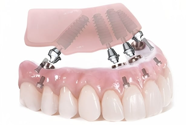 all on 4 dental implants burton