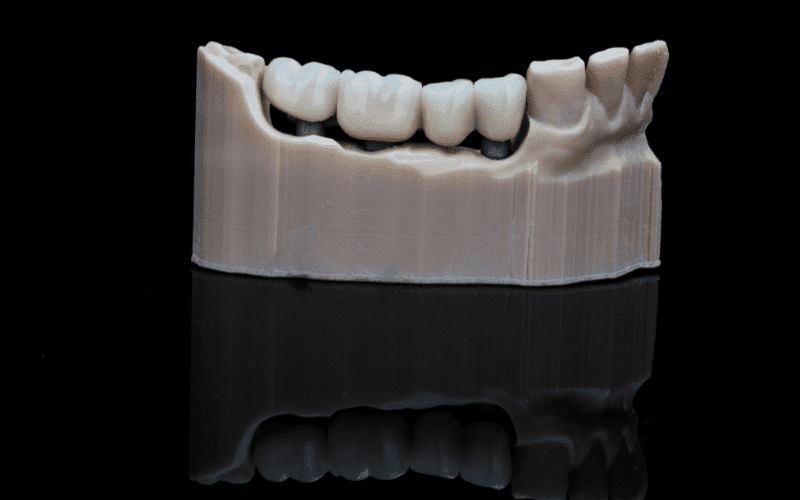 Cause a Dental Bridge to Fail