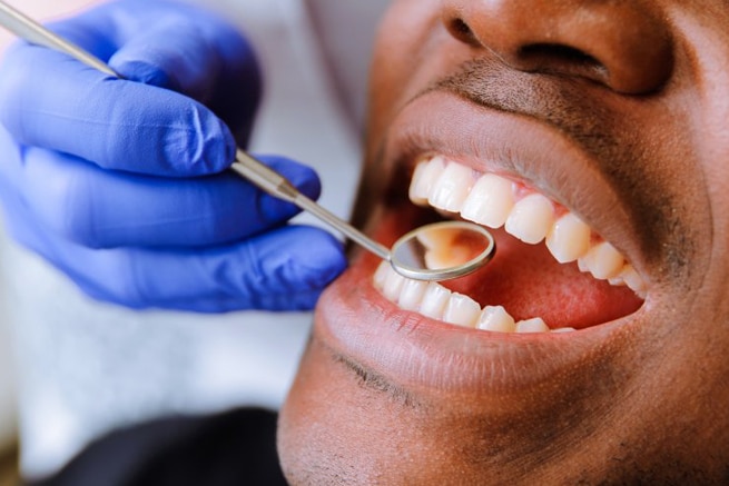 dental cleaning burton