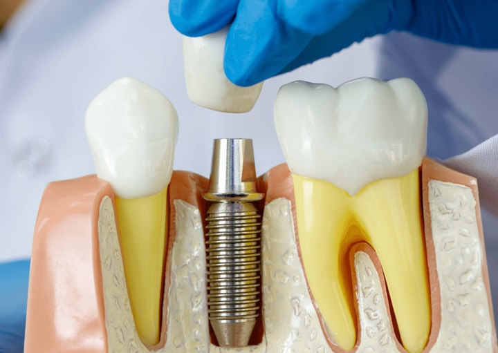 dental implants burton