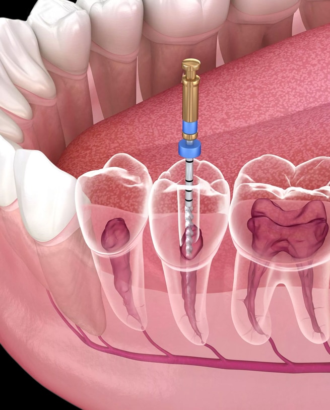 root canal therapy burton