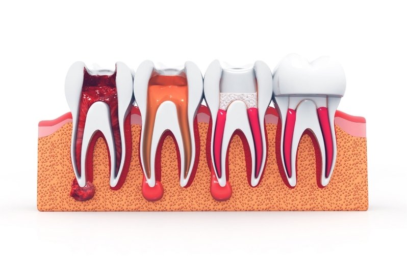 root canals impact your bite and jaw health