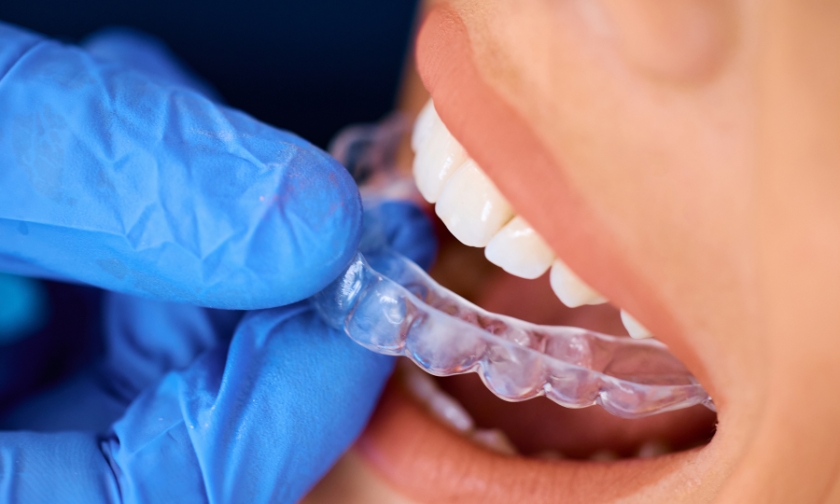 SureSmile® Aligners burton