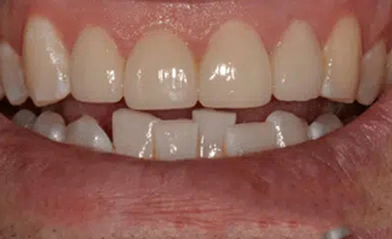 Dental Bridges in Burton