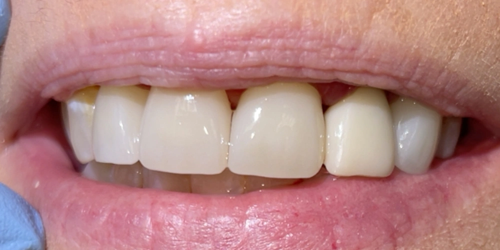 Dental stories after 4 Camarillo Premier Dental, Dental office 1000 by 500 pixels
