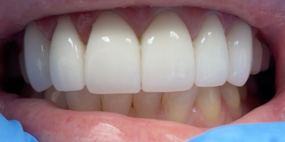 after dental treatment