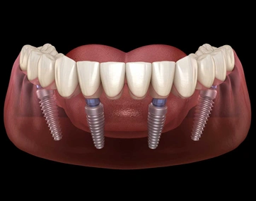 All Dental Implant