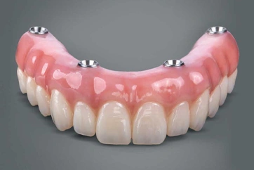 Retained Dentures
