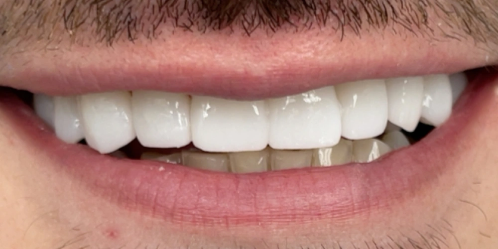 Smile Gallery After