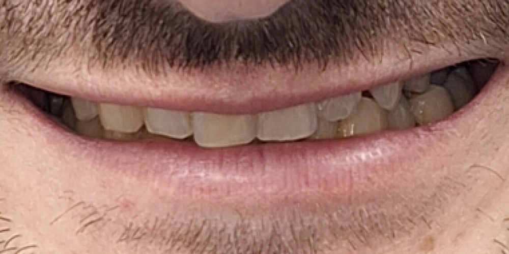Smile Gallery Before