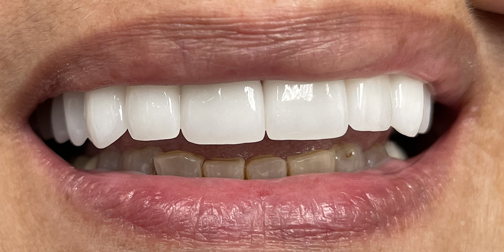 Smile Gallery After