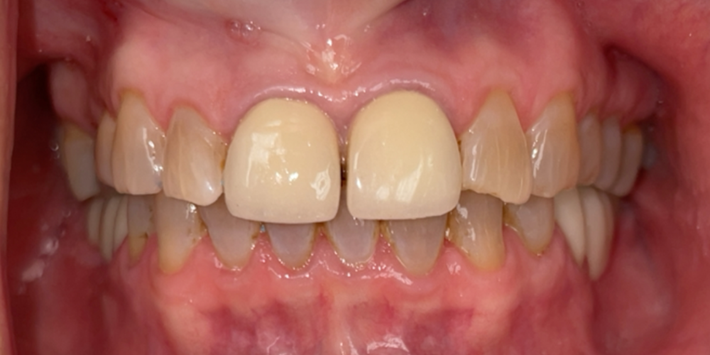 Smile Gallery Before