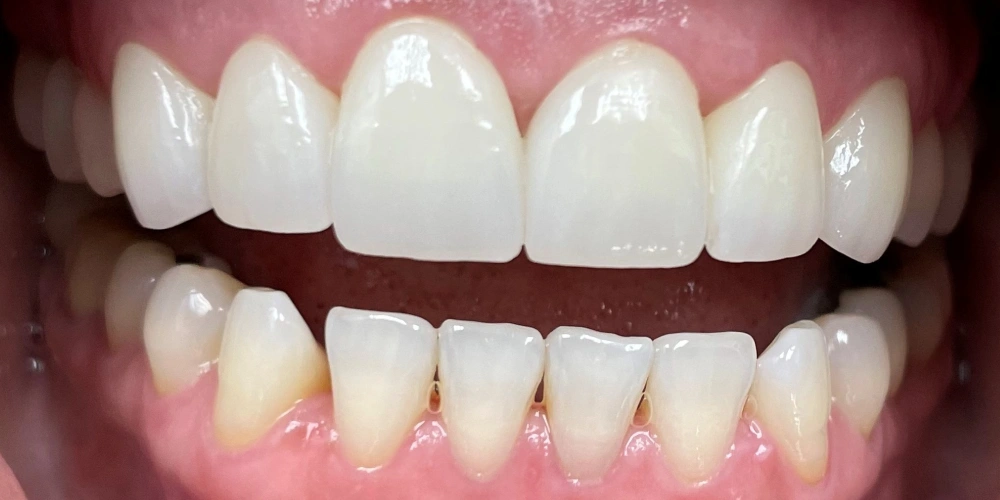 Smile Gallery After