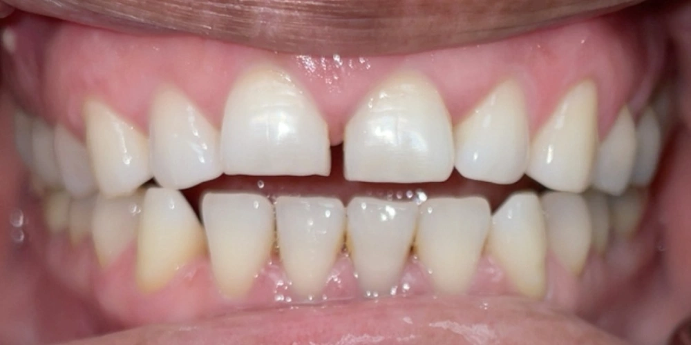 Smile Gallery Before