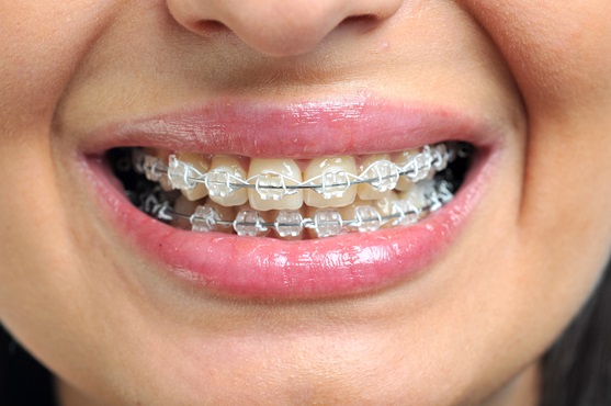Top Cosmetic Treatments Offered by Camarillo Premier Dental