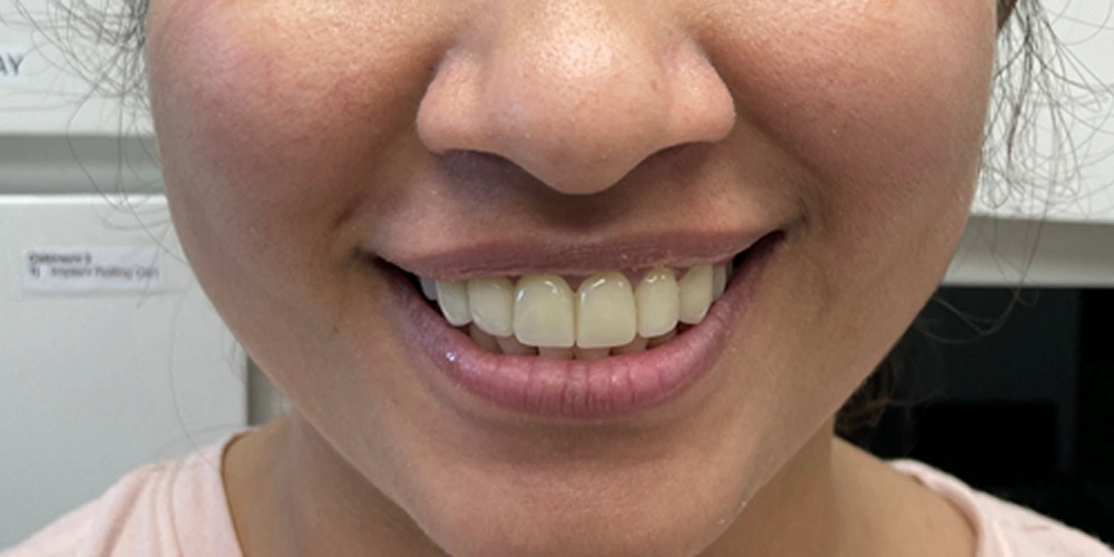 Smile Gallery After