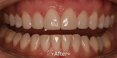 Smile Gallery After