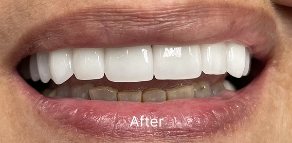Smile Gallery After