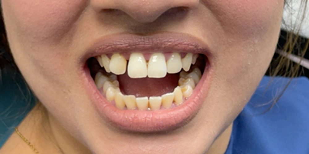Smile Gallery Before