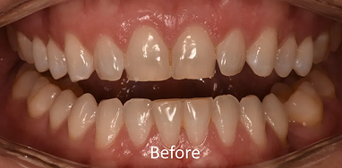 Smile Gallery Before
