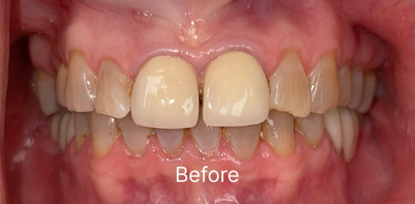 Smile Gallery Before