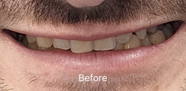 Smile Gallery Before