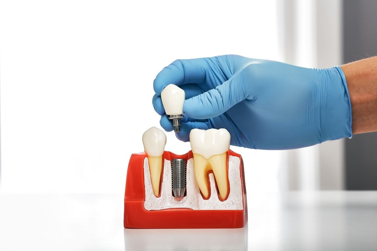 How Long Do Dental Implants Take to Heal?
