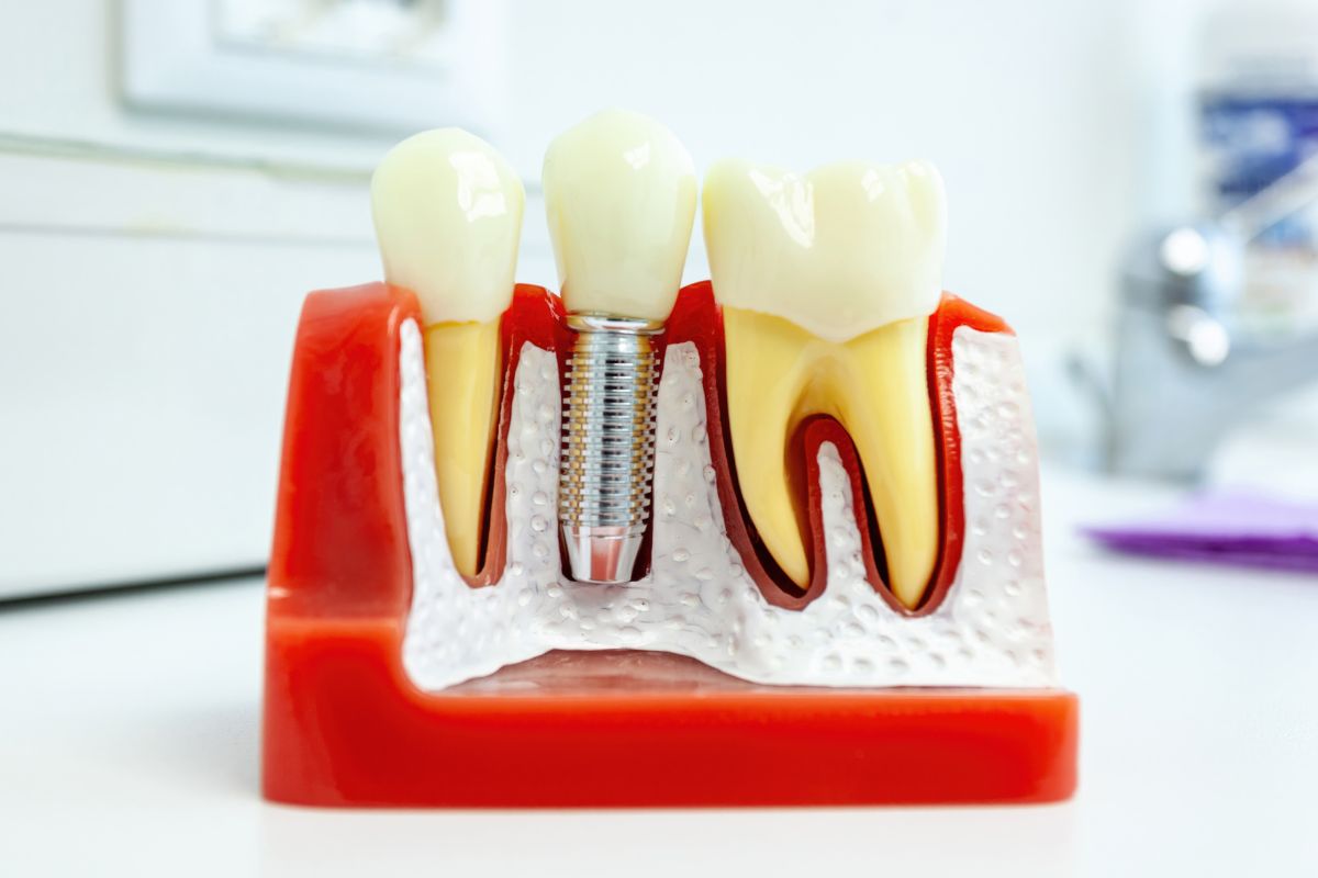 Dental Implants: What You Need to Know