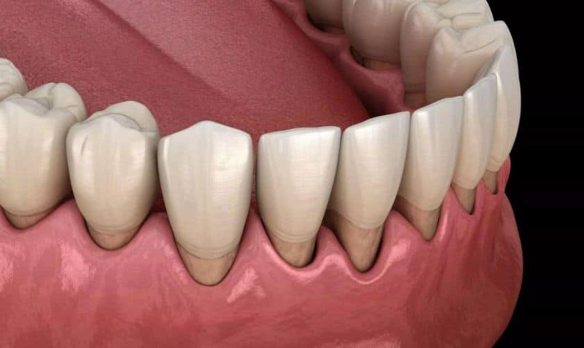 How to Prevent the Gum Disease Known as Gingivitis?