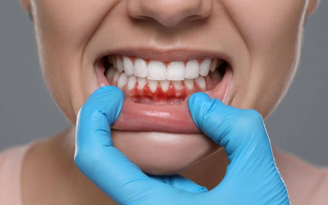 Understanding the Stages of Gum Disease: A Comprehensive Guide