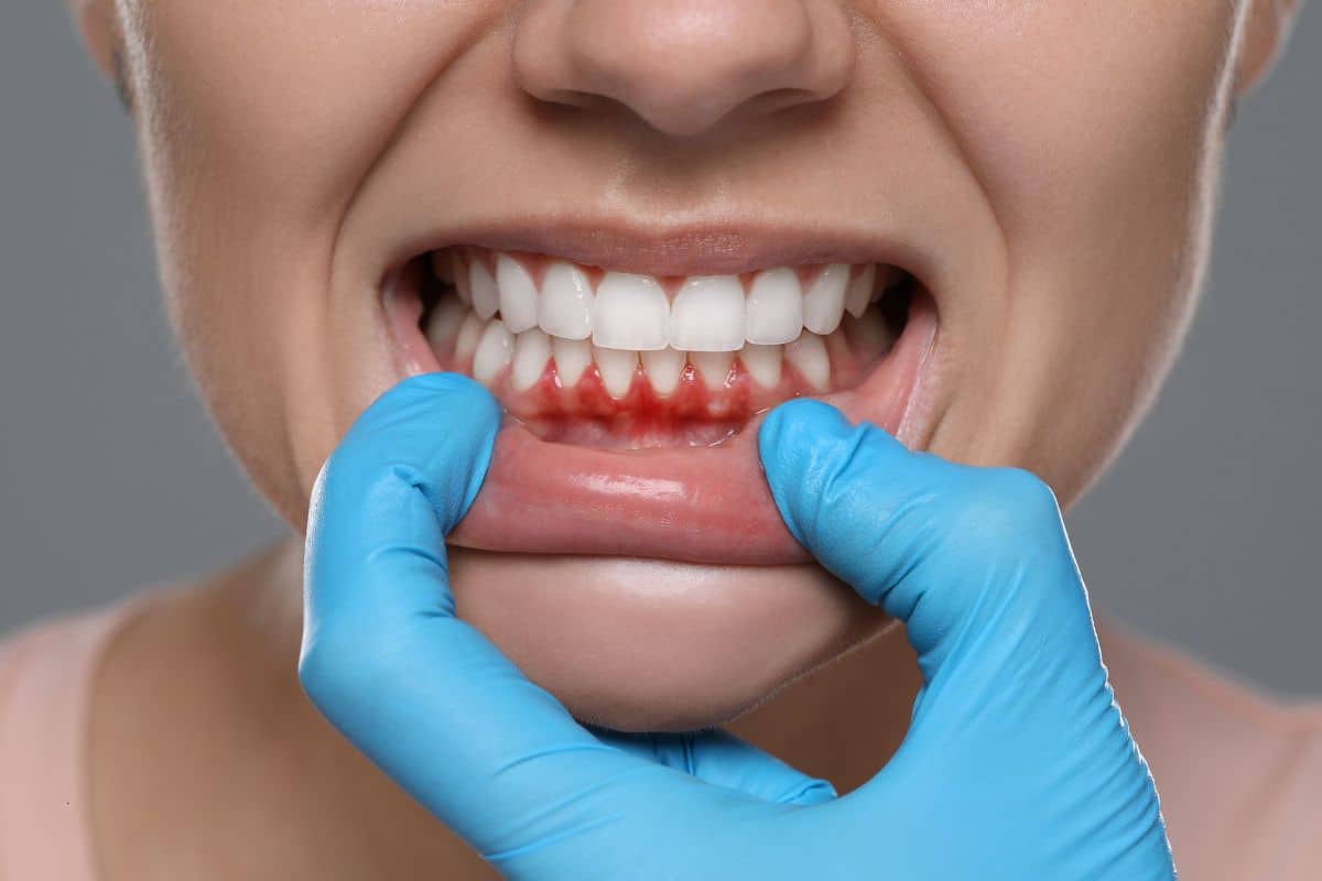 stages-of-gum-disease Sandy Dentist