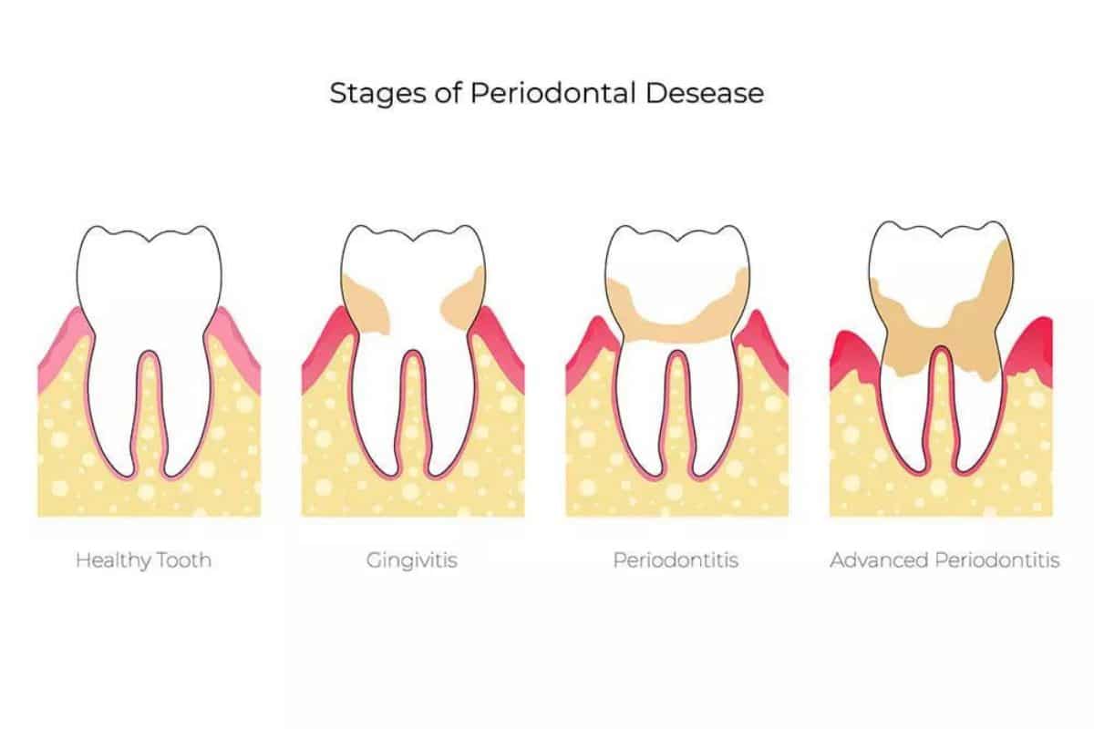 What are the Different Stages of Periodontal Disease Diagram showing four stages of periodontal disease progression in teeth, from healthy to advanced periodontitis.