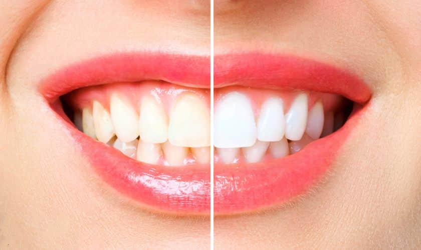 Teeth whitening Sandy