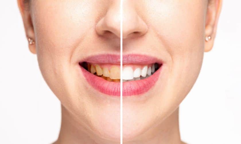 Teeth Whitening Sandy Illuminate Your Smile: Discover The Magic Of Teeth Whitening In Sandy