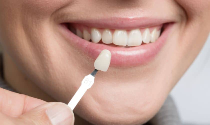 The Artistry Of Veneers: Transforming Your Smile With Cosmetic Dentistry