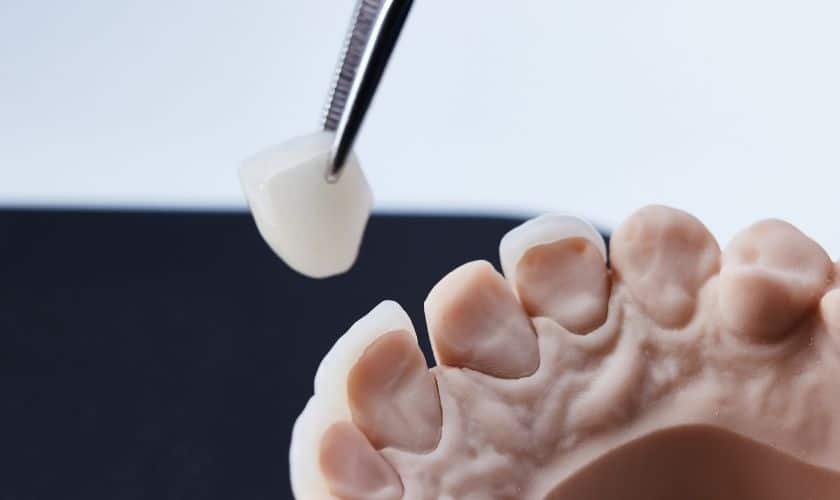 Modern Approach By Use Of Veneers In Sandy