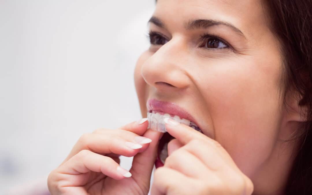 Types of Mouthguards: Choosing the Right One for You
