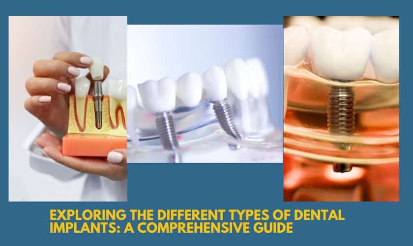 Dental Implants Sandy