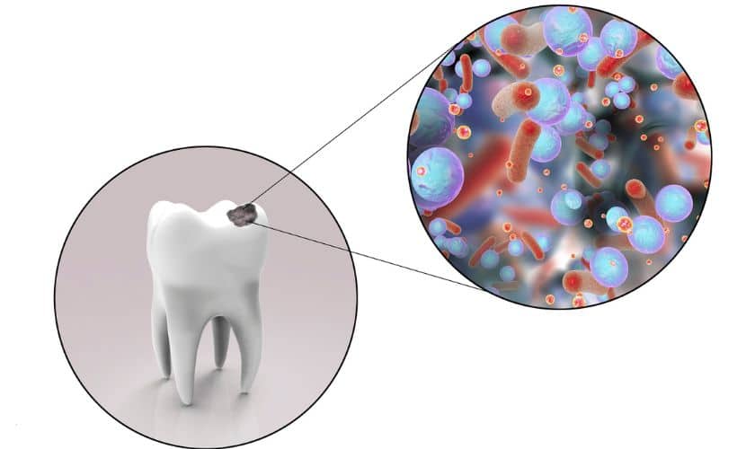 early-detection-and-prevention-of-cavities Sandy Dentist