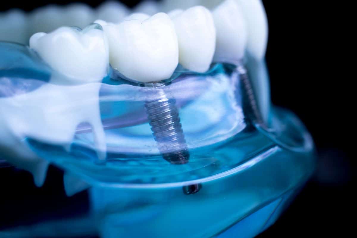 Dental Implants Sandy