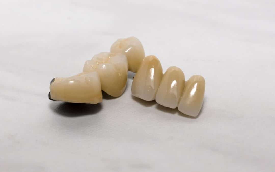 Top 5 Reasons to Choose Same Day CEREC Crowns for Your Dental Needs