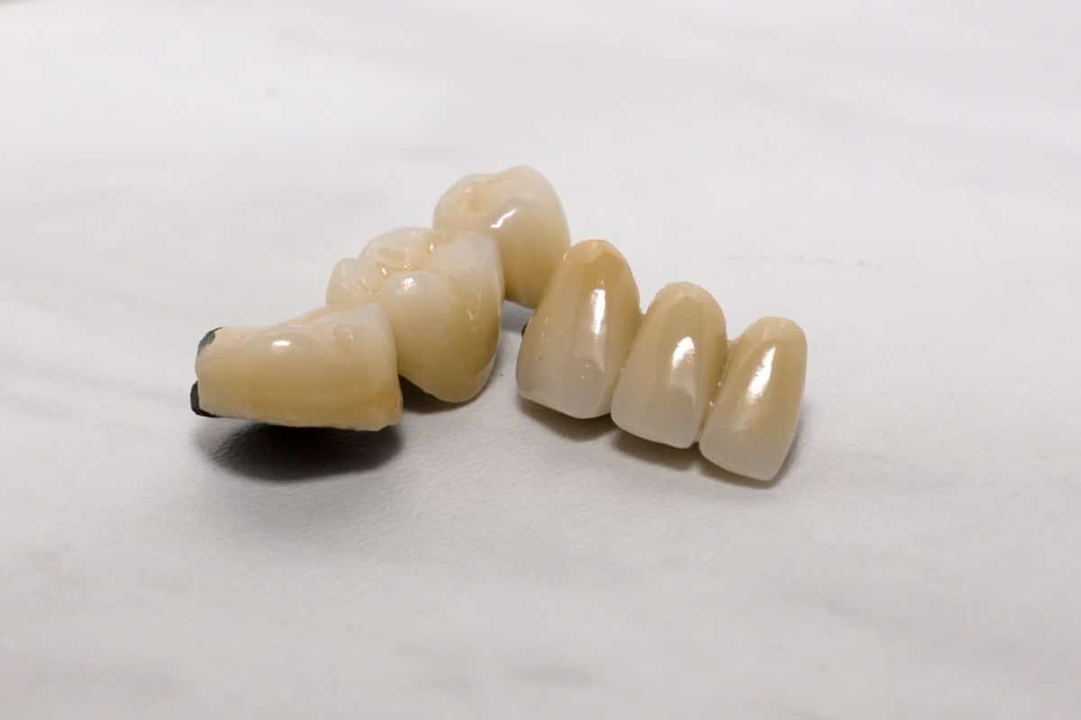 reasons-choose-same-day-cerec-crowns dentist in sandy ut